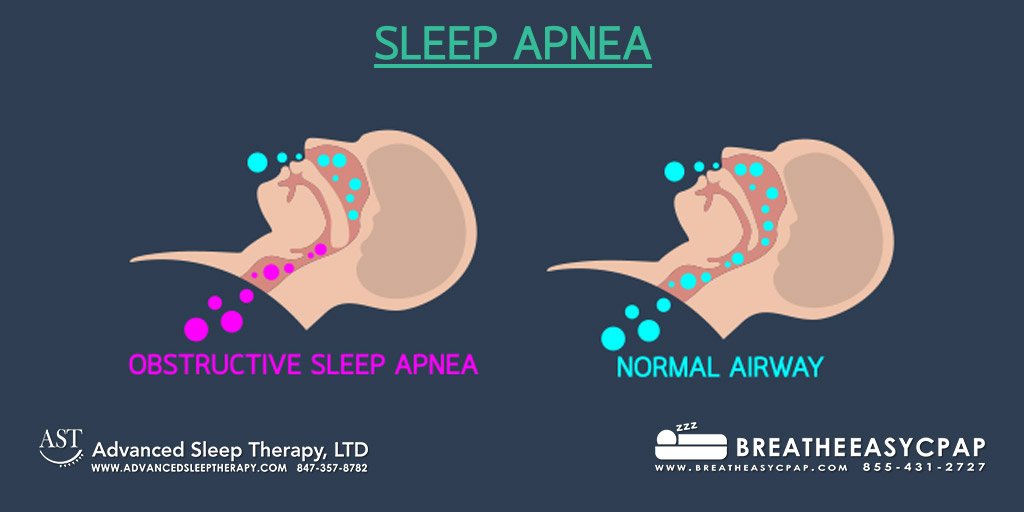 What Is Definition Of Sleep Apnea